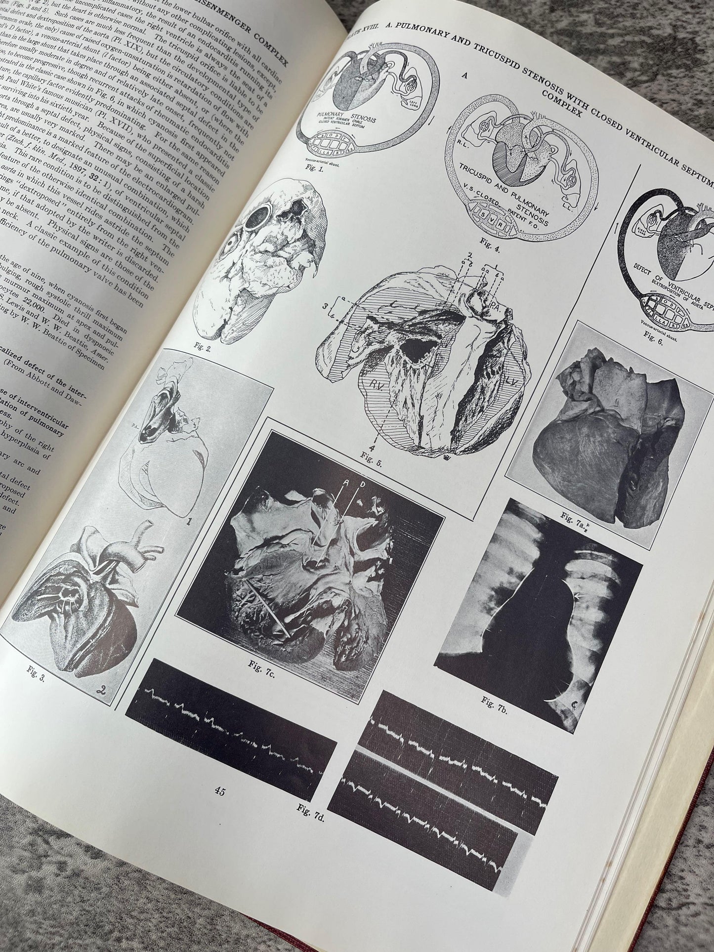 Atlas Congenital Cardiac Disease / Second Edition / c1954 - Precious Cache